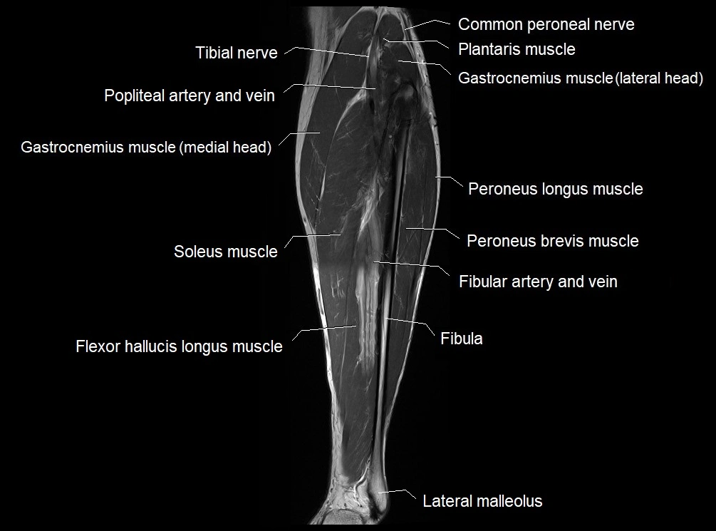 MRI 3T leg (tibia & fibula) labelled coronal cross sectional anatomy image 21.webp